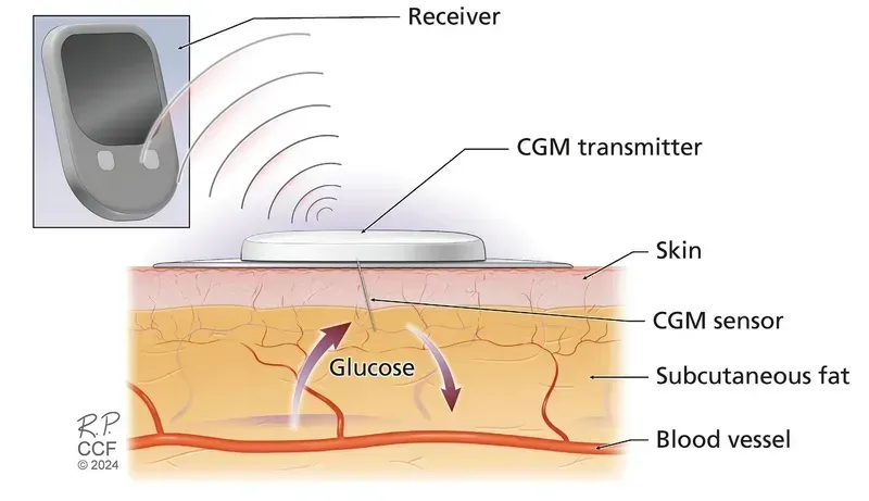 Close-up of glucose monitoring patch with visible internal sensors and circuits